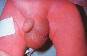 Inguinal Hernia in Boy, presenting as a groin swelling.