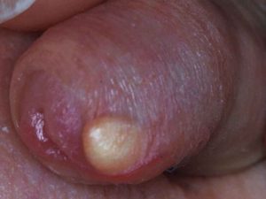 On filled penis bump STD Symptoms