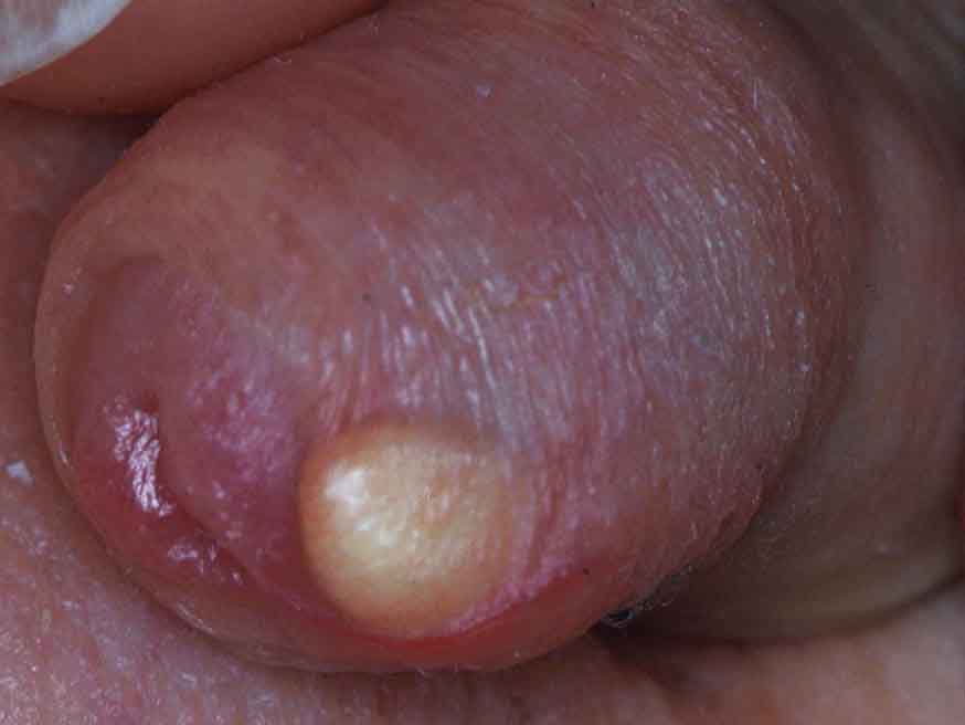 Smegmal Cyst - Mr Andrew Robb