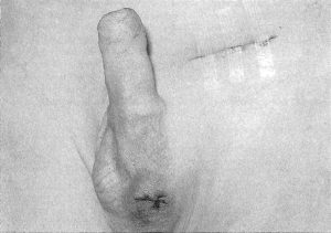 Scrotal and inguinal wounds after an orchidopexy