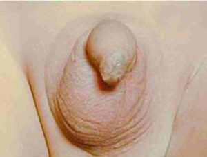 Empty left hemiscrotum - typical appearance of an undescended testicle
