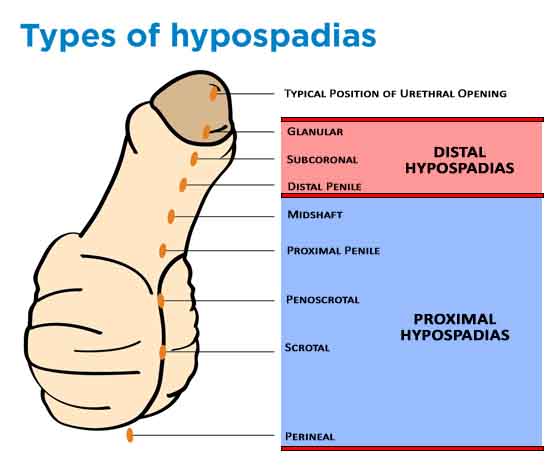 Distal vs Proximal Hypospadias