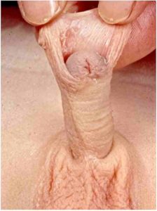 Penis with hooded foreskin