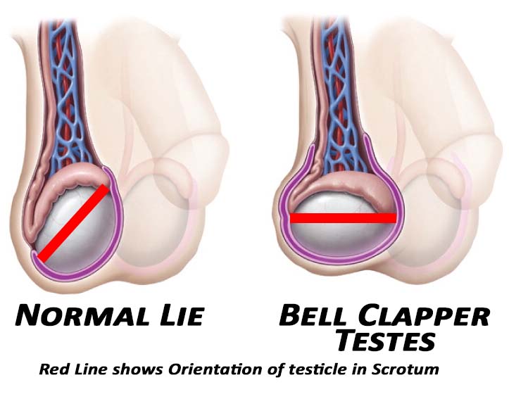 Testis lies in the scrotumt compared to a Normal Testis